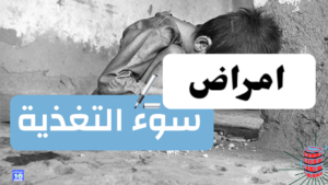 امراض سوء التغذية